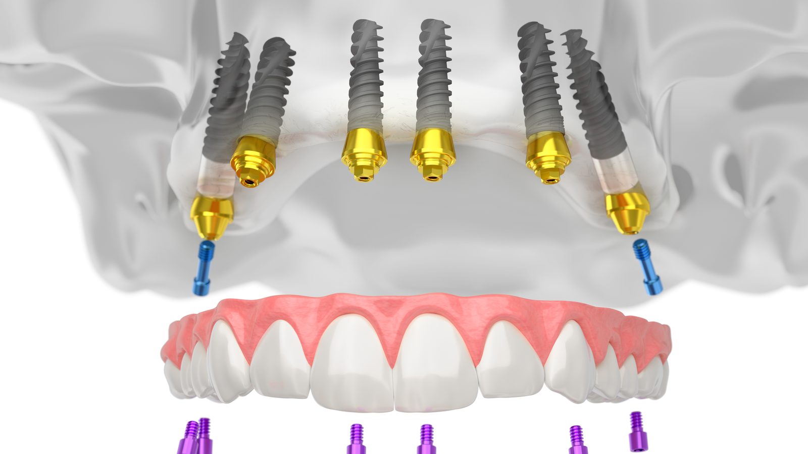 Digitale Implantatplanung mit sechs Implantaten im Oberkiefer